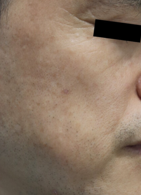 Skin Booster Treatment Results After