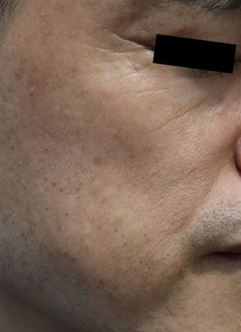 Skin Booster Treatment Results Before